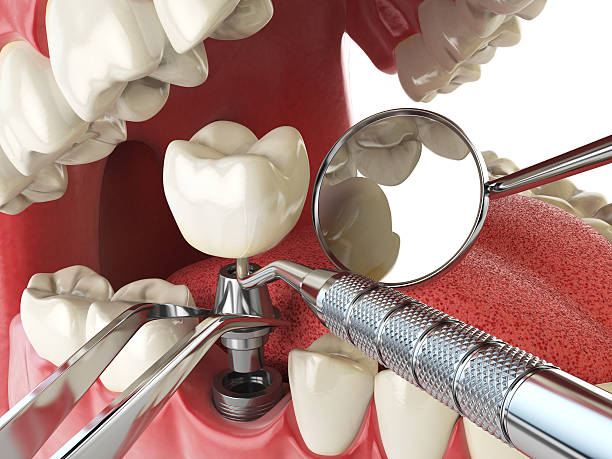 Best Emergency Treatment for Dental Infections or Abscesses in Cumberland, WI